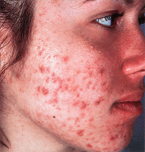 Severe Acne